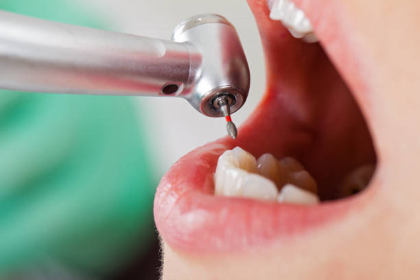 Best Emergency Gum Treatment in San Miguel, CA